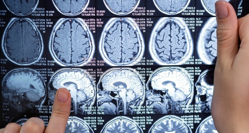 Identifican proteínas novedosas implicadas en la neurodegeneración de las formas más discapacitantes de la esclerosis múltiple
