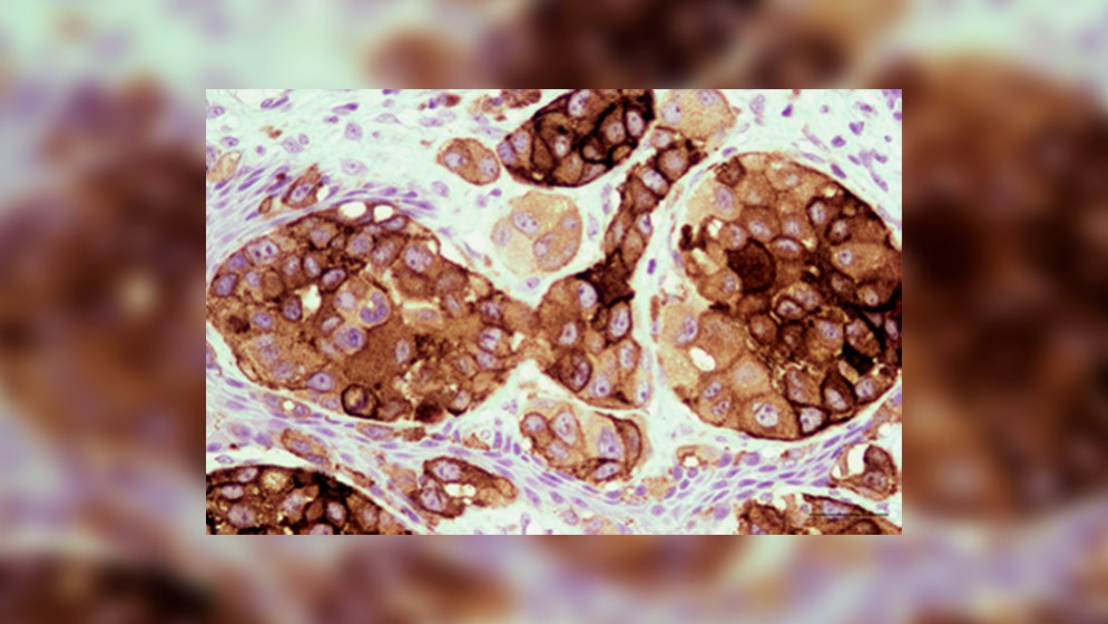 Estudio clínico fase II: vacuna contra el melanoma prolonga la sobrevida sin metástasis