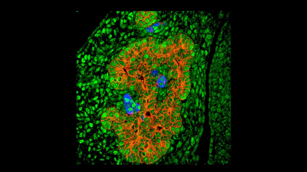 Diabetes tipo 1: nuevo hallazgo para generar células beta productoras de insulina con fines terapéuticos