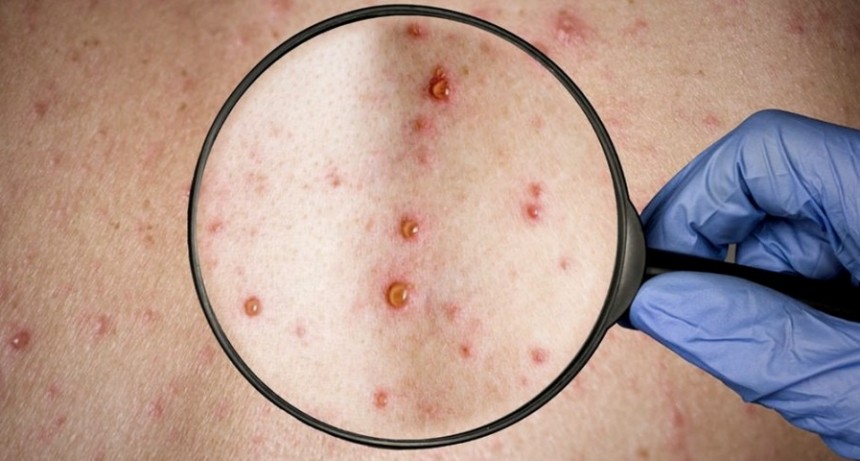 El Ministerio de Salud confirma el tercer caso de viruela símica en el país