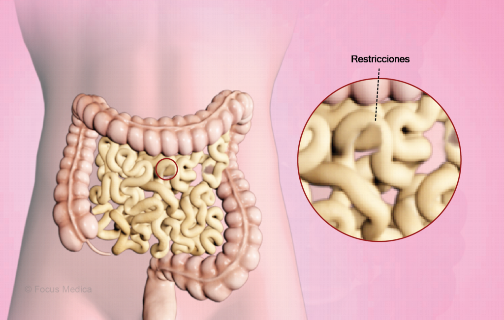 ¿Qué es una obstrucción intestinal?