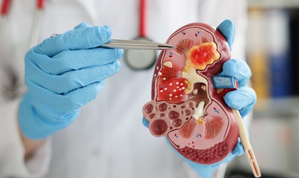 Estiman que para 2045 los casos de cáncer de riñón aumentarán en la Argentina más del 50%