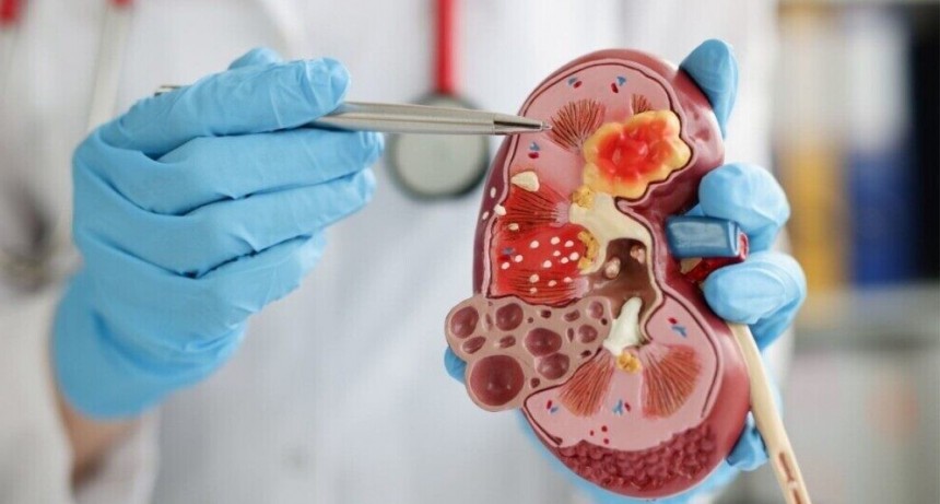 Estiman que para 2045 los casos de cáncer de riñón aumentarán en la Argentina más del 50%