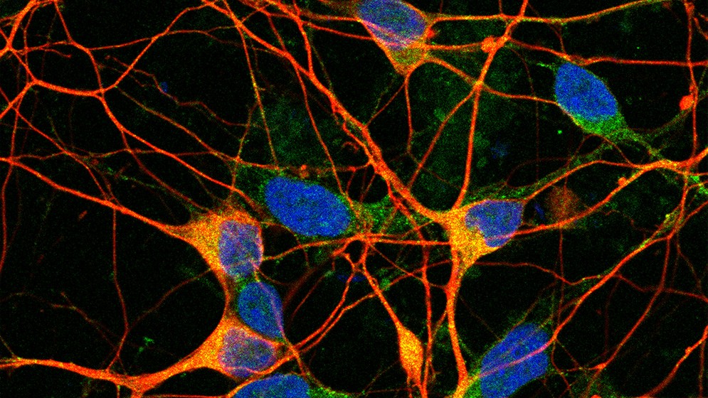 Investigadores reciben subsidios de la Alzheimer´s Association para buscar posibles terapias contra la enfermedad neurodegenerativa