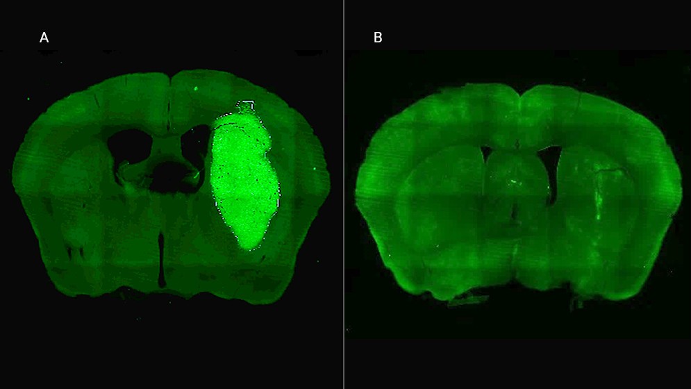 Especialistas del CONICET logran frenar un tipo de cáncer cerebral en estudios preclínicos con una novedosa estrategia terapéutica