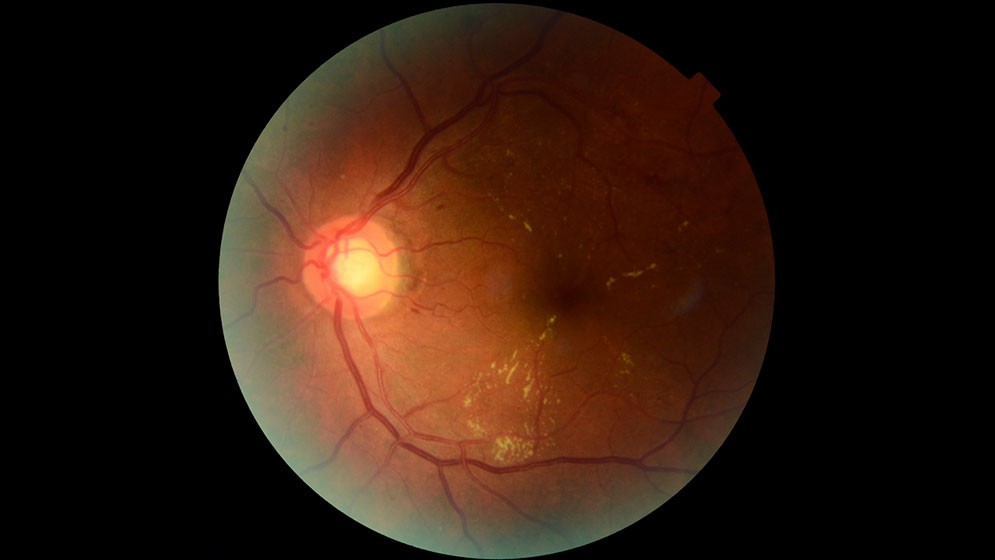 Retinar: la inteligencia artificial desarrollada por investigadores del CONICET que busca prevenir la p&eacute;rdida visual en personas con diabetes