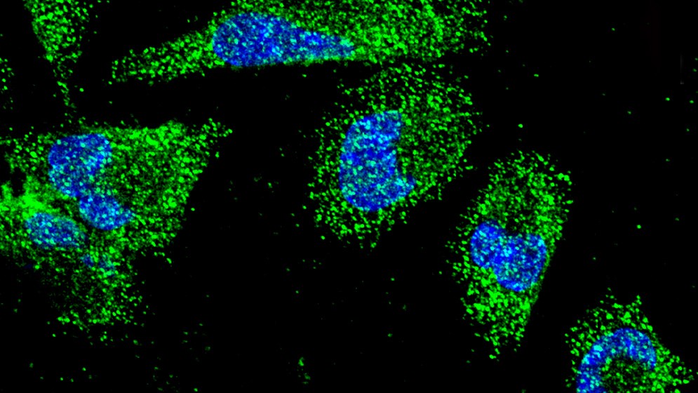 Descubren c&oacute;mo se comunican las c&eacute;lulas del c&aacute;ncer pancre&aacute;tico m&aacute;s frecuente para sobrevivir a condiciones adversas