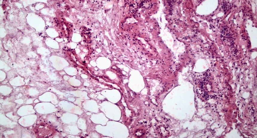 Revelan que el c&aacute;ncer renal modifica las c&eacute;lulas grasas de su entorno y genera condiciones que podr&iacute;an favorecer su progresi&oacute;n