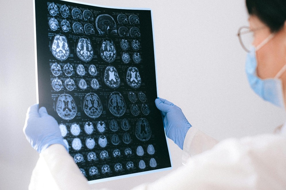 Identifican en sangre biomarcadores relevantes para el diagnóstico y el seguimiento de pacientes con epilepsia