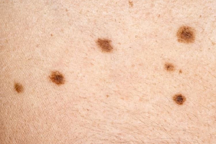 Crecen los casos de cáncer de piel en todas las edades