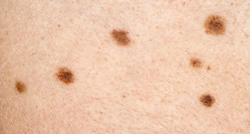 Crecen los casos de cáncer de piel en todas las edades