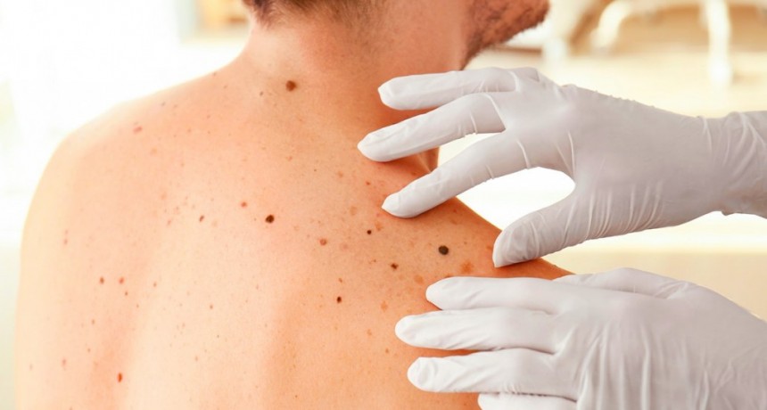 Morón se suma a la campaña federal “Salvá tu Piel” con chequeos gratuitos y jornadas de prevención