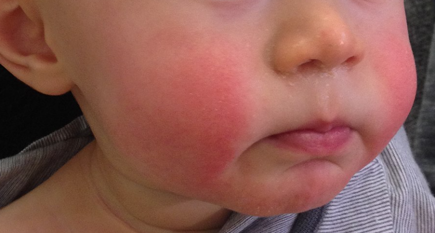  Yvonne Cossart, la viróloga australiana que descubrió el virus que pone las mejillas coloradas a los niños